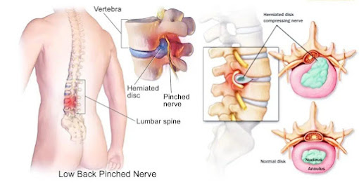 Health Care: आजकल कमर दर्द एक आम समस्या,  प्रमुख कारण और घरेलू उपाय